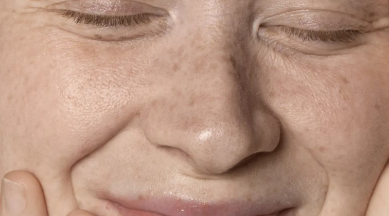 Mulheres são mais suscetíveis ao melasma; saiba por que e como prevenir